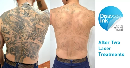 Laser removal progress