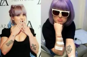 Celeb tattoo removal