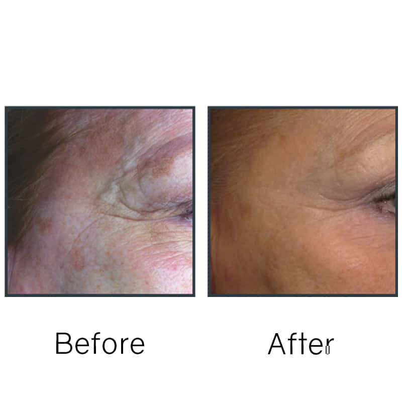 Before/After