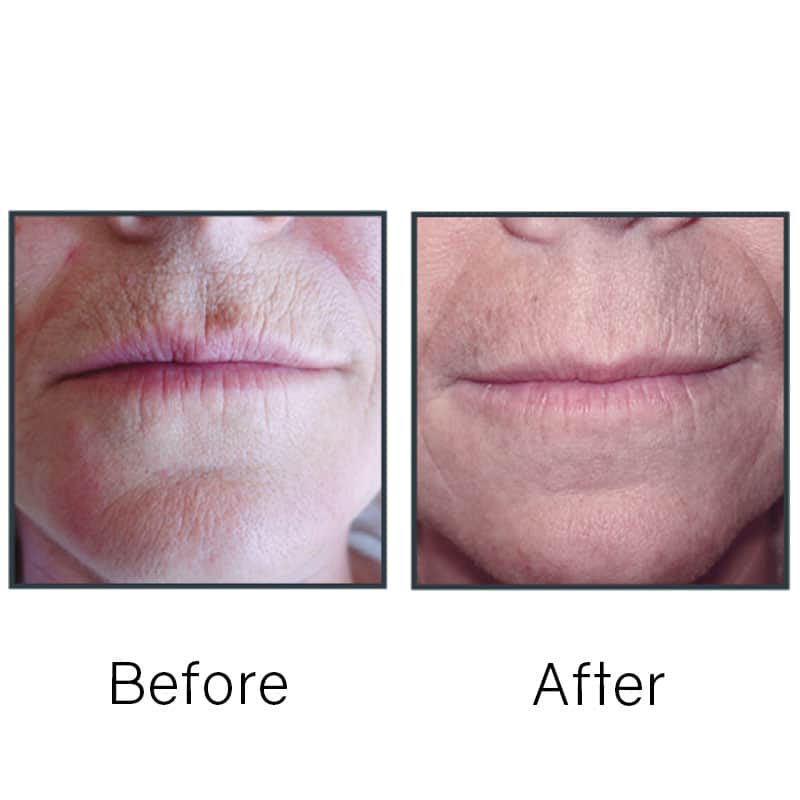 Before/After