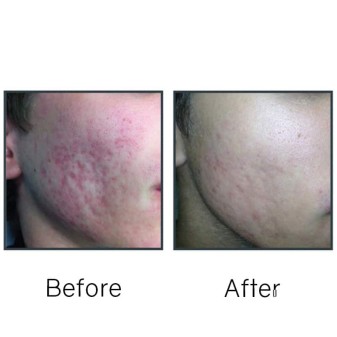 Before/After