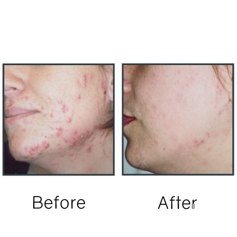 Before/After