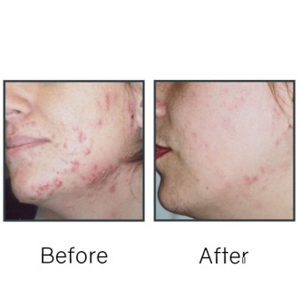 Before/After