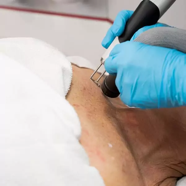 Laser skin resurfacing