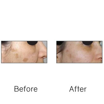 Before/After