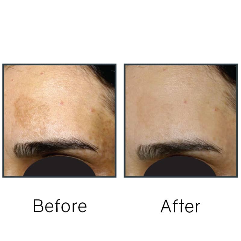 Before/After
