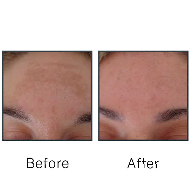 Before/After