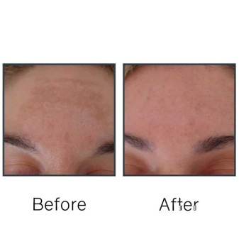Before/After