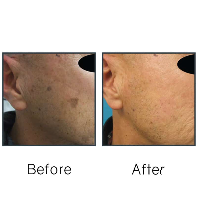 Before/After