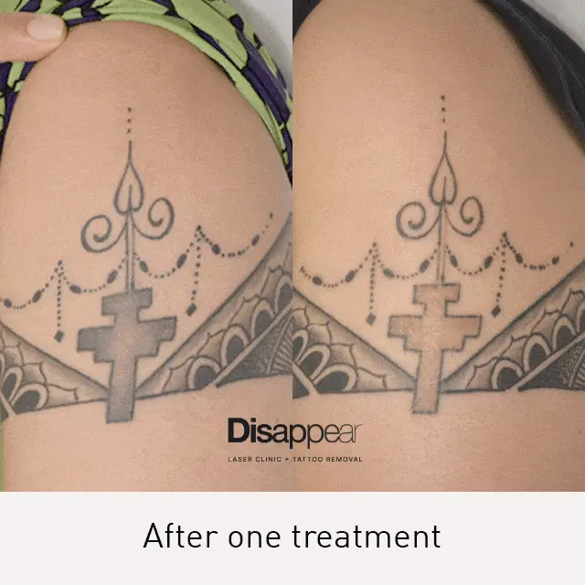 Tatto Removal - Before/After