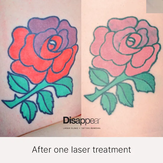 Tatto Removal - Before/After