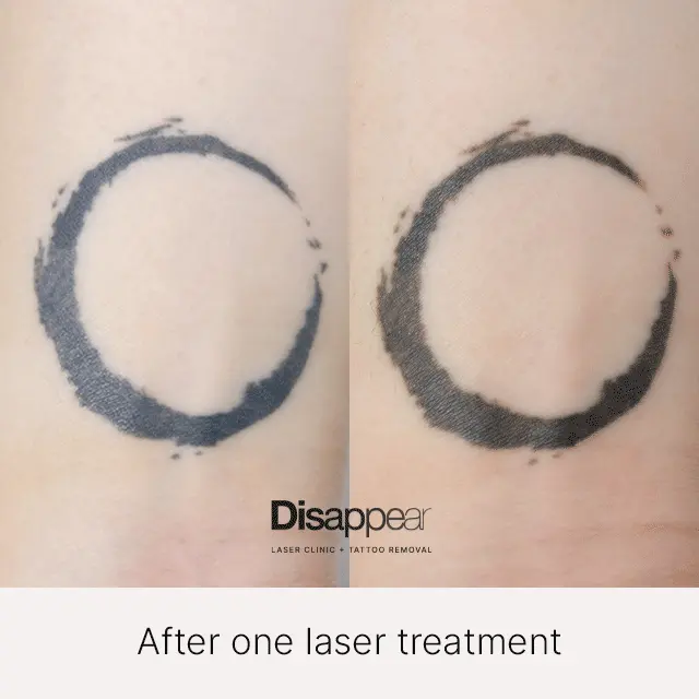 Tatto Removal - Before/After