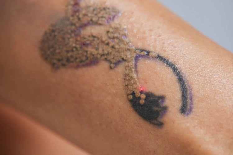 What You Should Know About Laser Tattoo Removal Side Effects