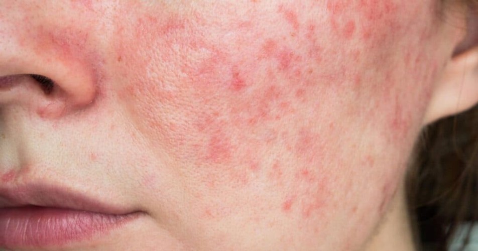 The 10 Best Treatments For Rosacea