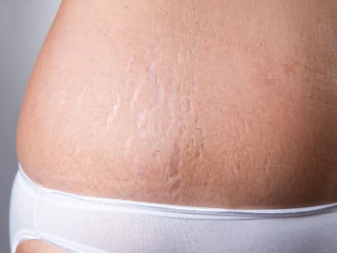 The 8 Most Effective Stretch Mark Removal Treatments