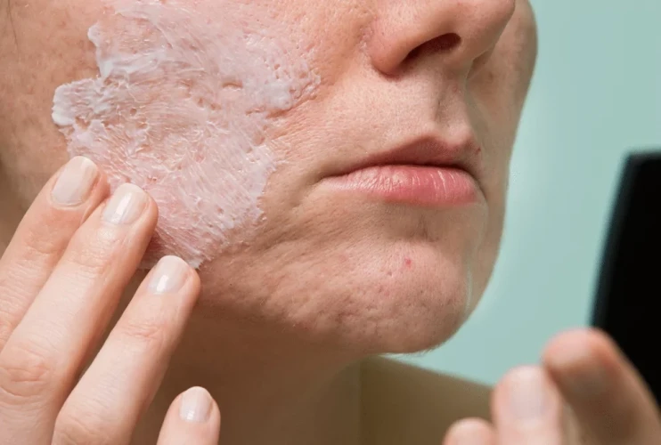 How To Remove Acne Scars In 8 Different Ways