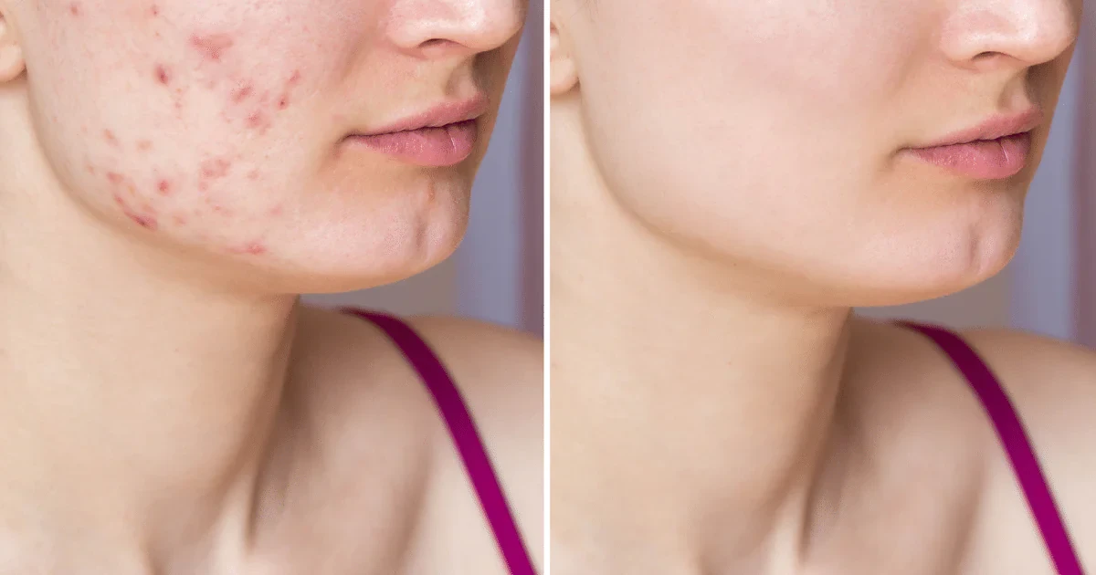 How Long Does It Take For Acne Scars To Fade? The 5 Stages Of Healing