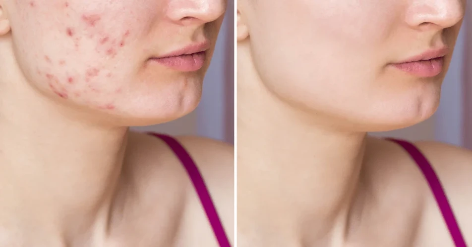 How Long Does It Take For Acne Scars To Fade? The 5 Stages Of Healing