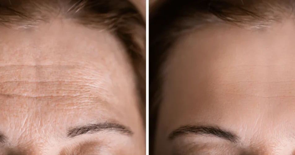 The Fascinating 4-Stage Evolution Of Forehead Wrinkles Treatment