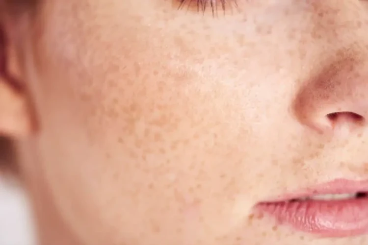 7 Alternatives To Laser For Freckle Removal